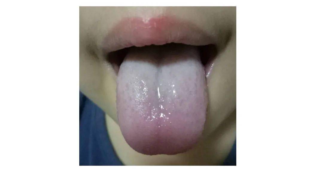 舌苔腻(或水滑),舌苔黄厚腻(一般是湿气重已经化热了),舌体胖大有齿痕