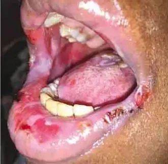 2 累及下唇,颊粘膜,硬腭,软腭和舌的糜烂性口腔炎