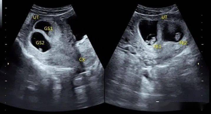 双胎妊娠超声检查小问答_绒毛