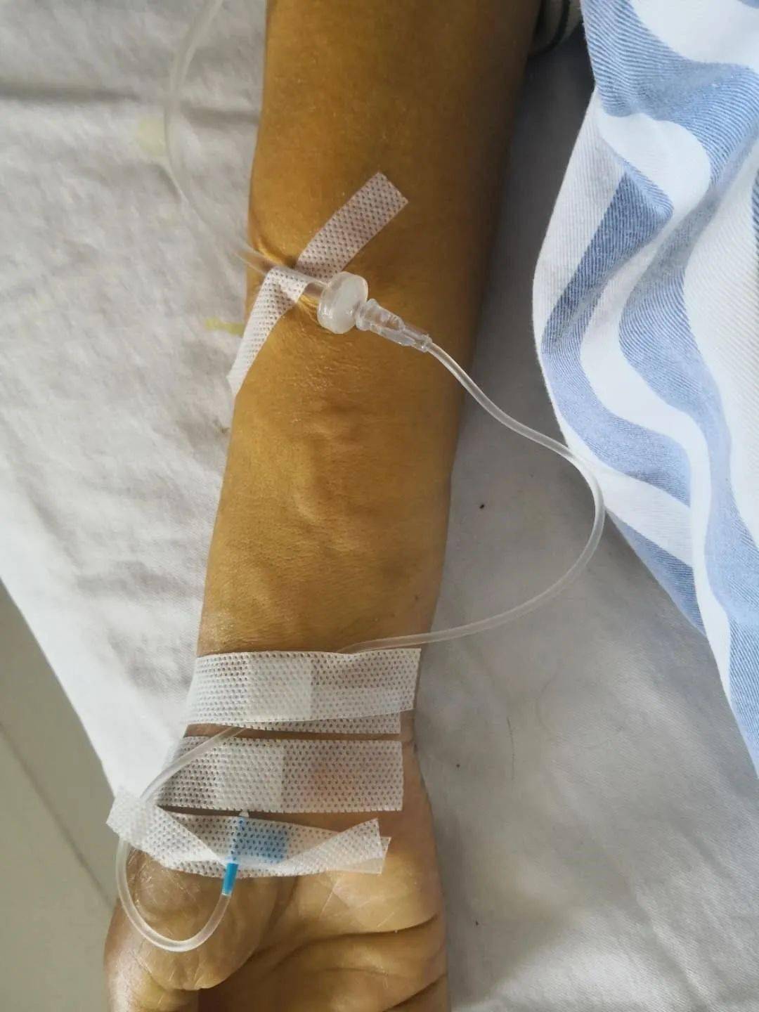 患者说输液的胳膊有点疼像蚂蚁爬