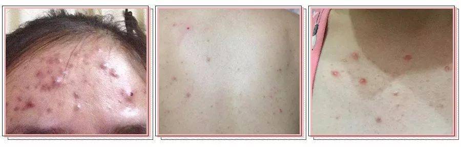 皮肤科的医生告诉我们 这一切的罪魁祸首是: 螨虫 以下是皮肤上螨虫的