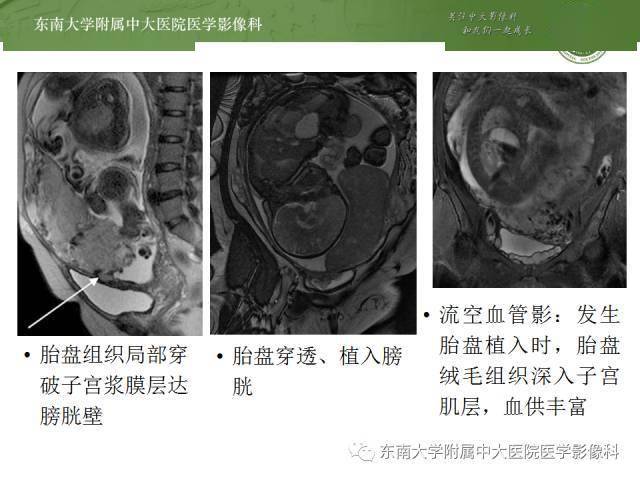 核磁共振胎盘植入图片图片