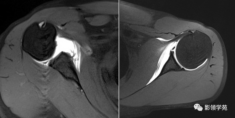 肩关节解剖及常见疾病影像表现