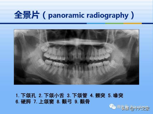 牙体牙周正常解剖及常见病x线表现