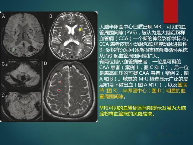 ms ) :中青年女性; 症狀發作與緩解交替出現;直角脫髓鞘徵;不同時期脫