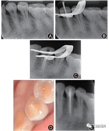 下頜第一前磨牙變異根管的診斷和治療4例報告