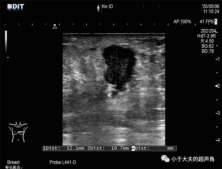 确诊病例小黑板080 乳腺浸润性导管癌 解析_分类