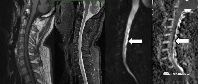 17种脊髓病变影像解读你get了吗