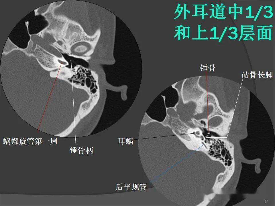 颞骨断层解剖及ct三维重建