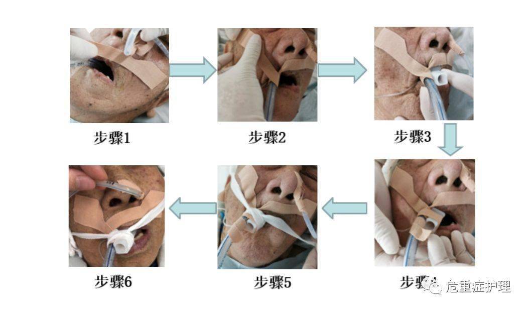 口咽通气管固定方法图片