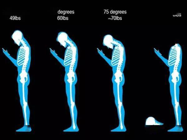 驼背颈椎痛肘超伸等不良姿势的康复矫正方案