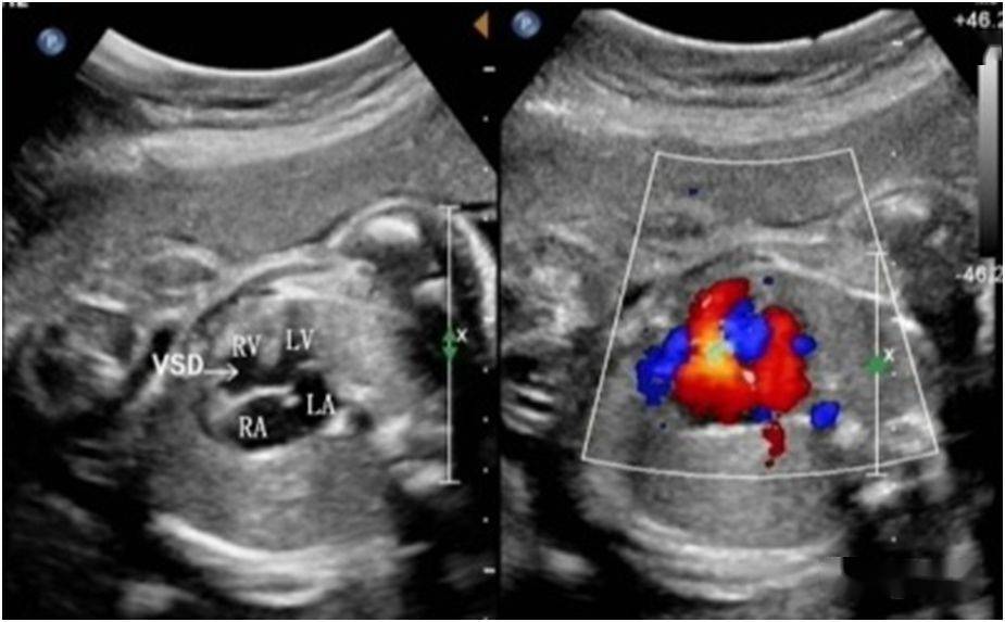 高手进阶:产前法洛四联症诊断