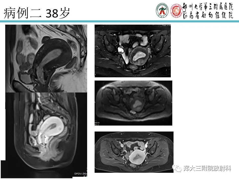 67子宮內膜息肉的影像診斷及鑑別