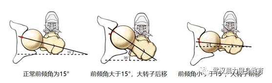 有幾種先天情況會導致假胯寬的情況: 1 ,股骨前傾角小於正常值,導致大