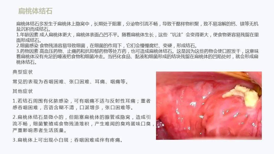 扁桃体详细解剖