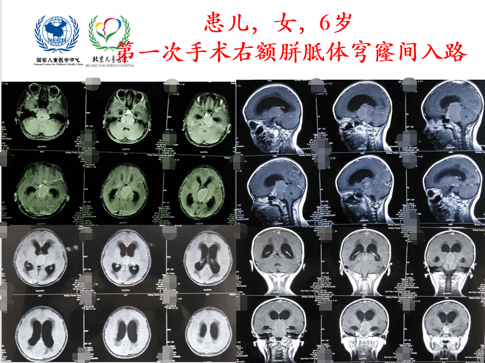 解剖课件 儿童鞍区肿瘤常见手术入路 北京儿童医院葛明