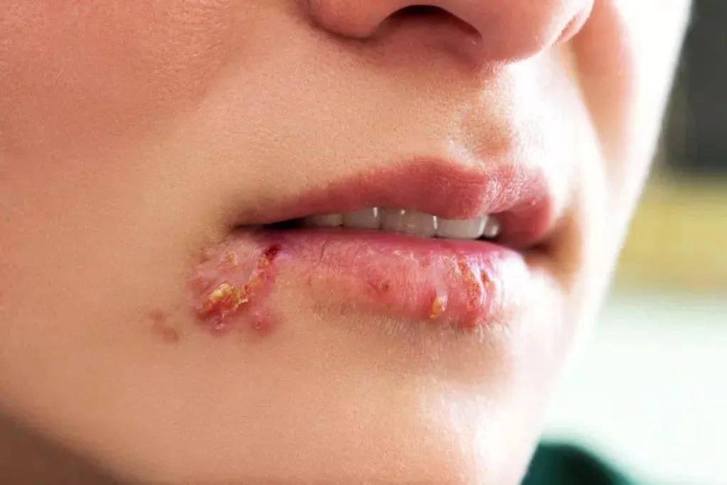 出现的情况非常常见,就是我们以为熬夜或者上火引起的唇疱疹(口疮)