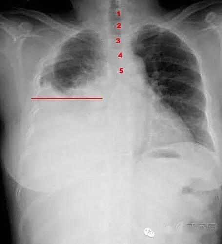 胸腔体表定位及胸腔积液量评估