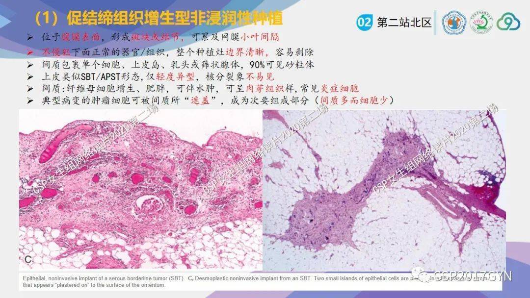 csp女性生殖组2020网络读片及讲座第二场(北区)