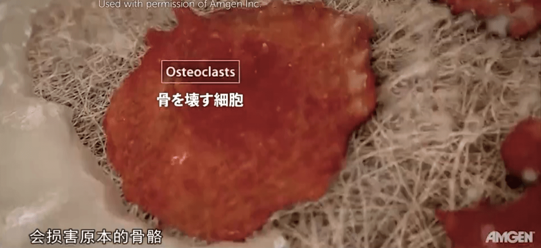 因上颚癌而去除了上颚,如果用普通的钛合金人工骨骼的话,需要随着年龄