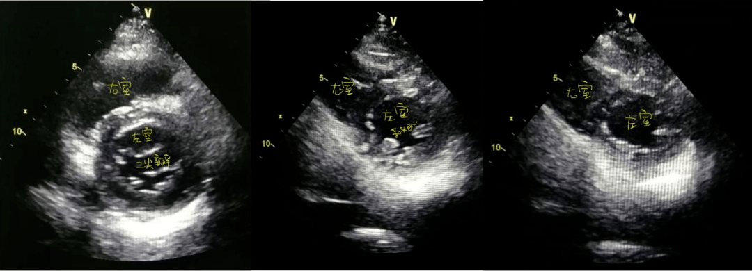 探頭繼續下壓,逐漸向心尖方向移動,依次可見二尖瓣水平短軸切面,乳頭