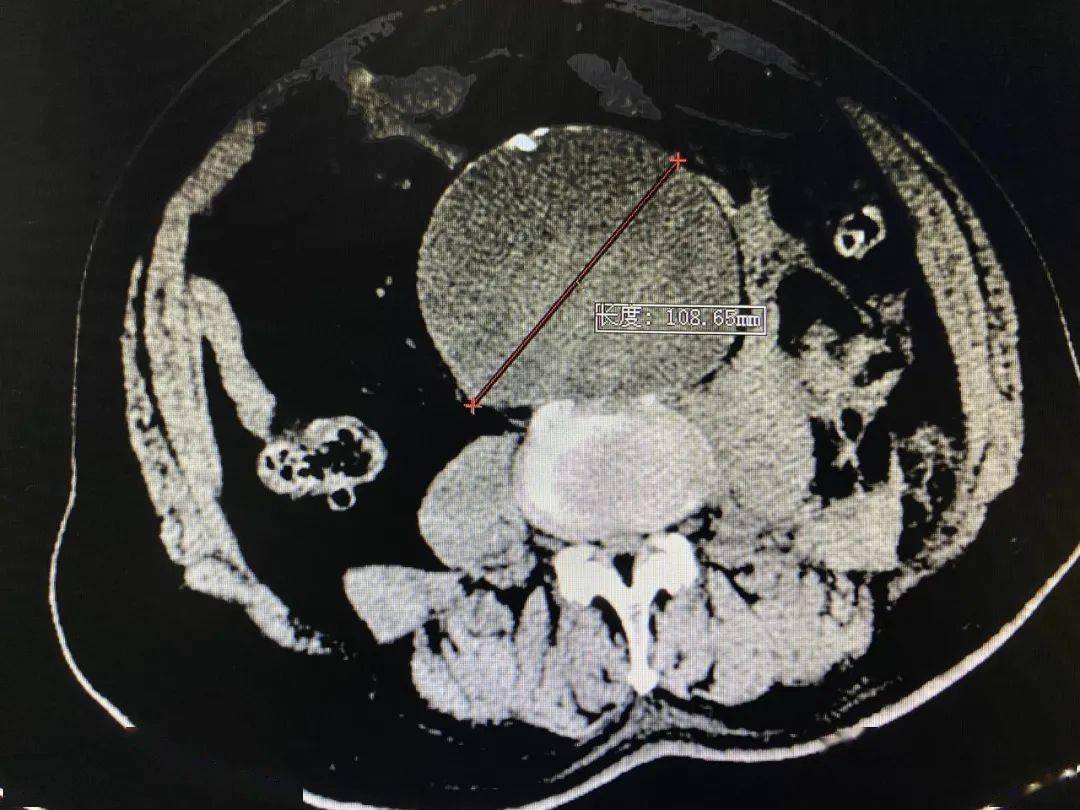 84岁李先生突然感到腹部疼痛难忍,腹部ct平扫显示腹主动脉瘤破裂