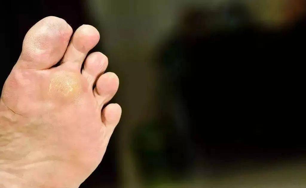 糖友们糖尿病足的四大症状出现一个就需警惕了