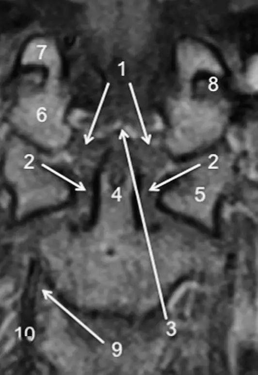 5,c1 侧块;6,枕骨髁;7,枕骨颈静脉结节;8,舌下神经管;9,c3 钩突;10,椎