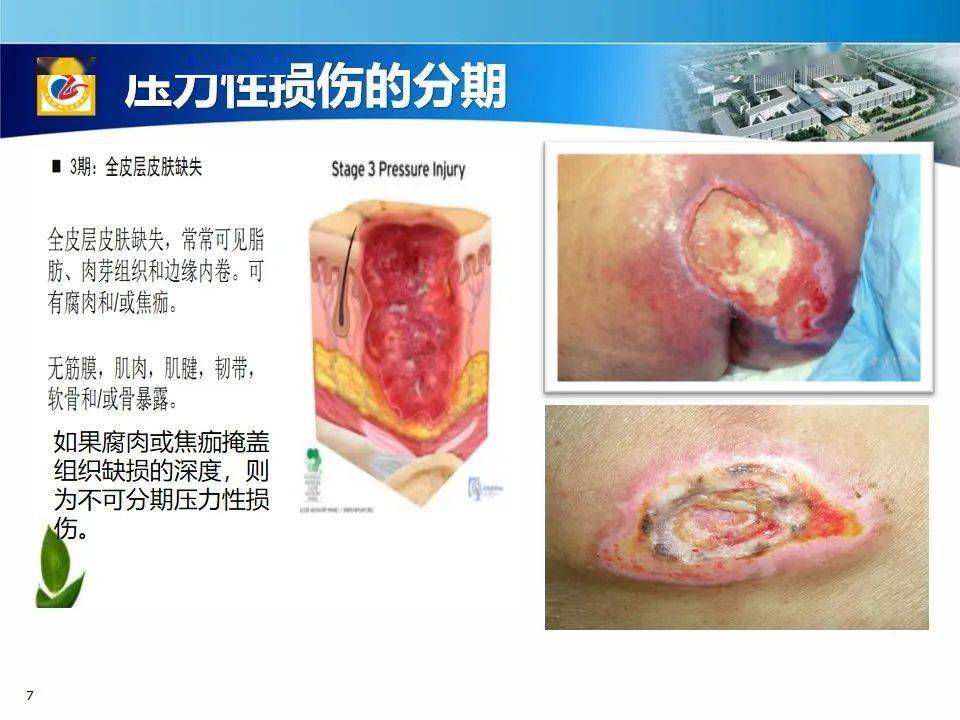 ppt压力性损伤新解读