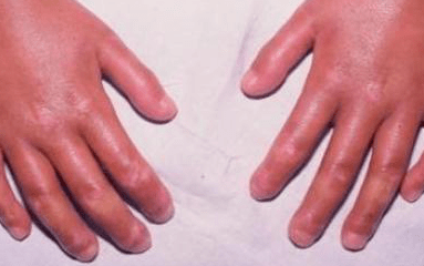 微信新用户怎么注册硬皮病要怎么处理