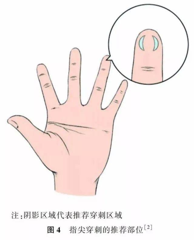 末梢采血最常见的部位就是指尖和足跟.