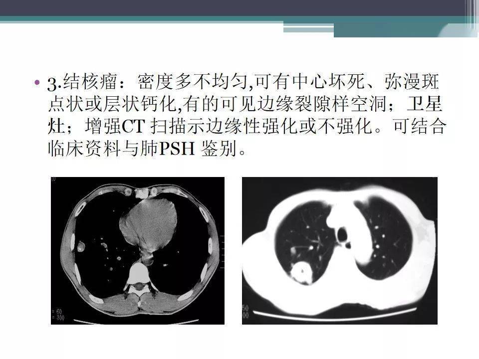 肺硬化性血管瘤psh影像表現