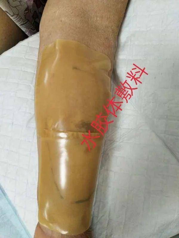 「经验分享」碘造影剂外渗怎么办?
