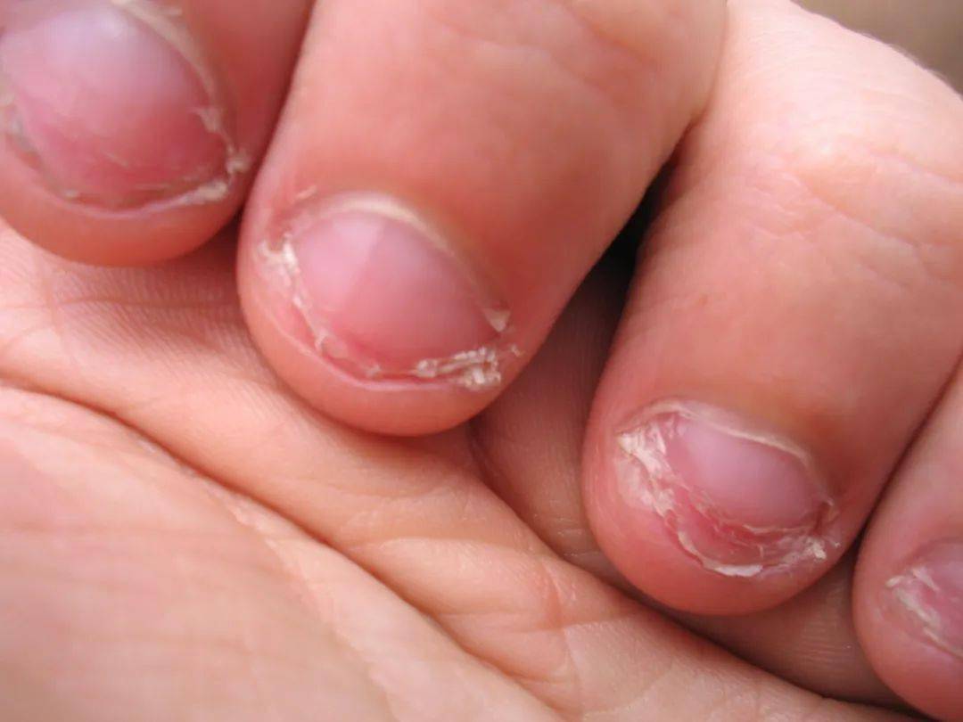 白血病的手指甲图图片