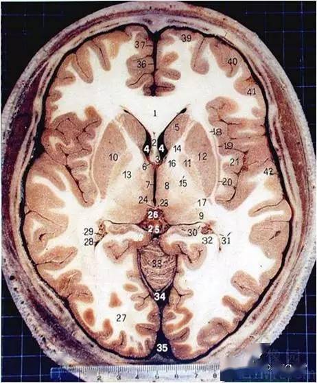 丘脑断层图片