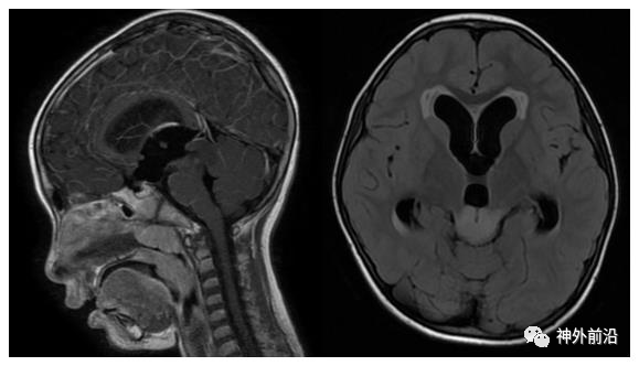 北京天壇醫院宮劍:兒童顱內腫瘤合併梗阻性腦積水的治療策略_手術