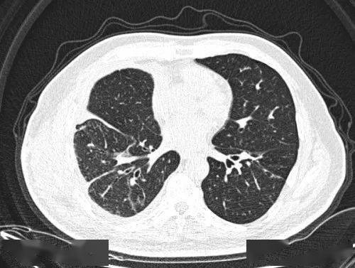 一经确认脓气胸或者脓胸(床旁超声是比较好的选择)需要紧急进行胸腔闭