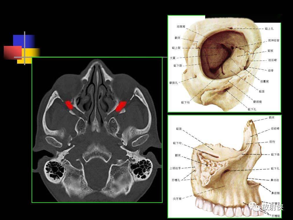 收藏必备鼻咽部的ct详细解剖