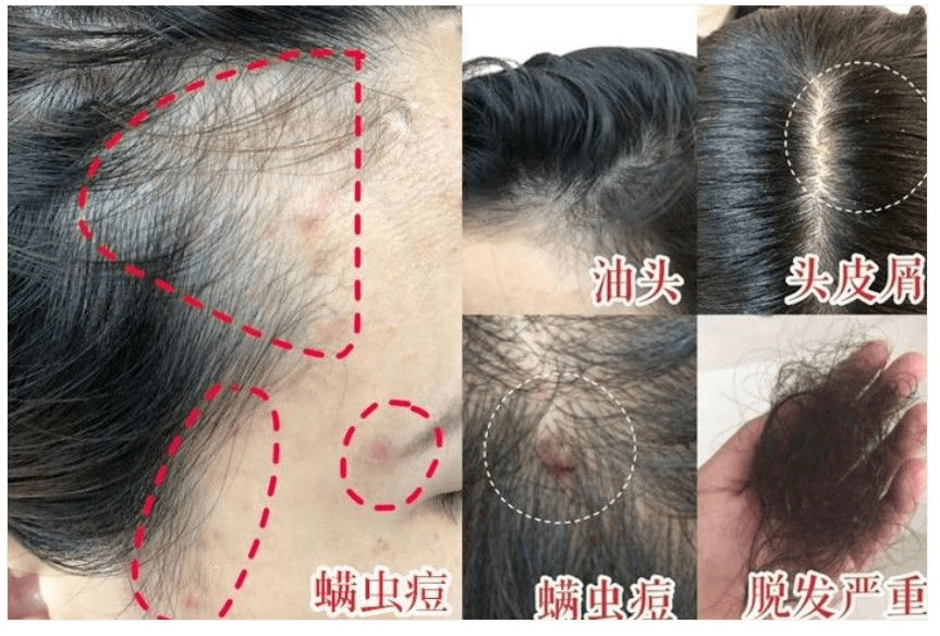 长痘痘,冒红疹疙瘩 反反复复全年不停 甚至涂了皮炎药膏都不管用