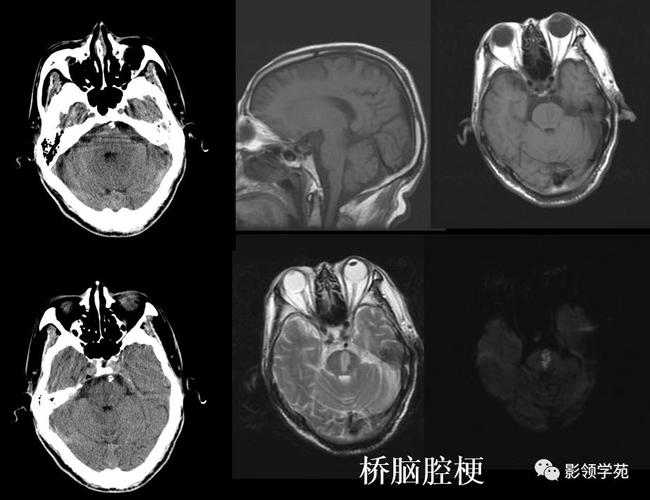 10種腦幹區常見病變影像表現