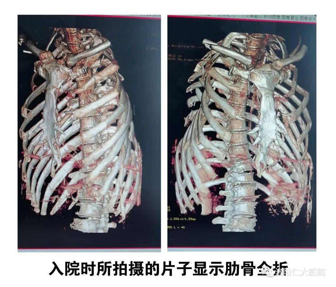 重型胸部擠壓傷患者重獲新生