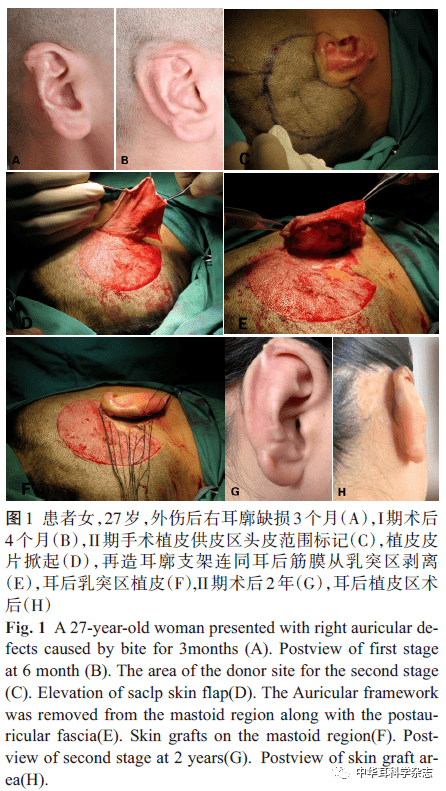 耳支架及其深面的筋膜组织一并掀起