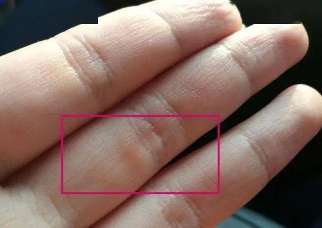 比如,他们的手指上会有老茧,因为长期手握铅笔造成的.