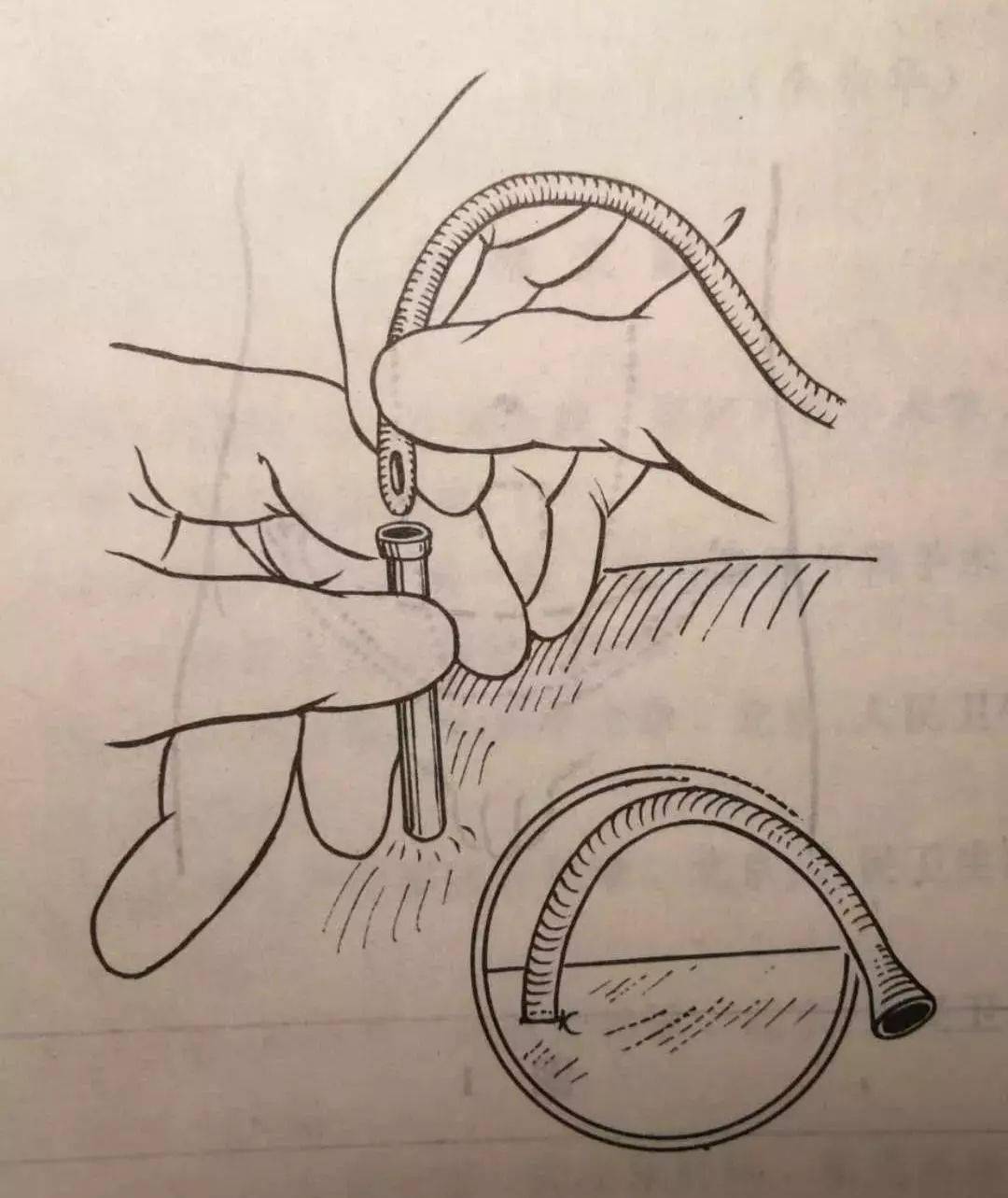 是长期插导尿管还是膀胱造瘘术您还在纠结吗