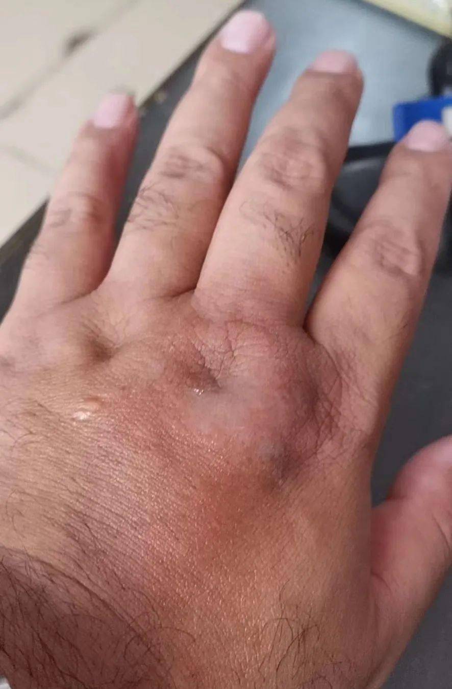 有人被洋毛辣子蜇到,肿的很厉害今天上午,小编在朋友圈也看到还不敢用