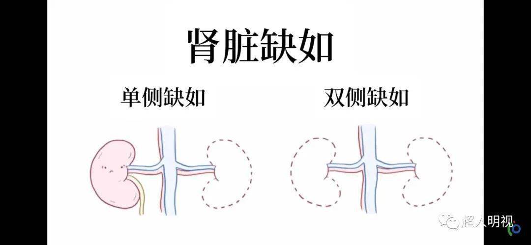 肾脏缺如的产前超声诊断必须重视