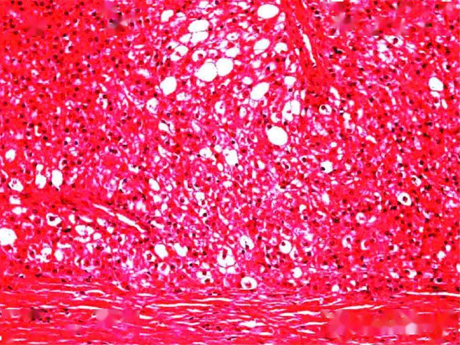 【超声随响】第05期 肝细胞腺瘤 hepatic adenoma