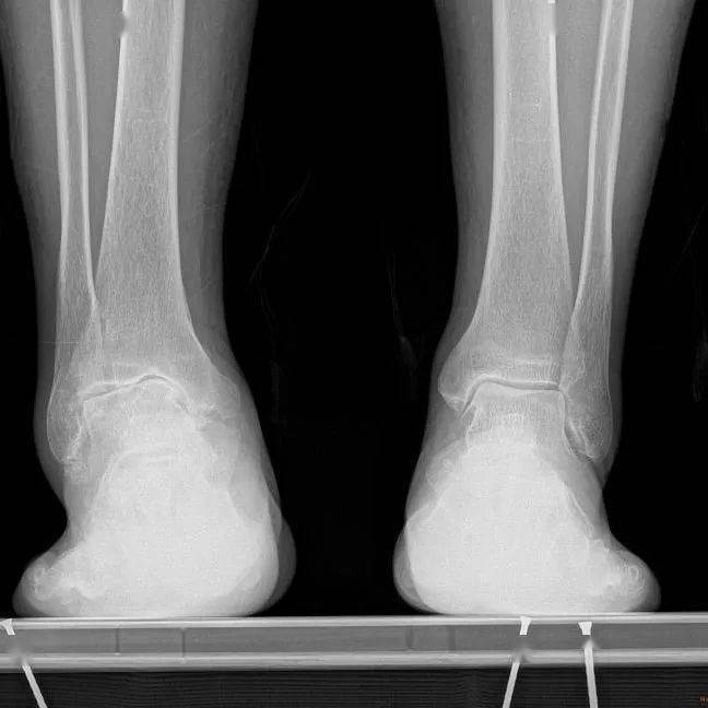 难忍疼痛,木老伯只能来瑞金医院骨科就诊,踝关节ct三维重建显示,木