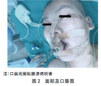 病例讨论副肿瘤天疱疮伴胸腺瘤手术的麻醉管理一例
