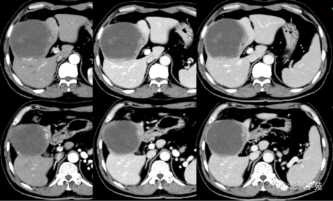 21种肝脏少见及不典型肿瘤的影像表现